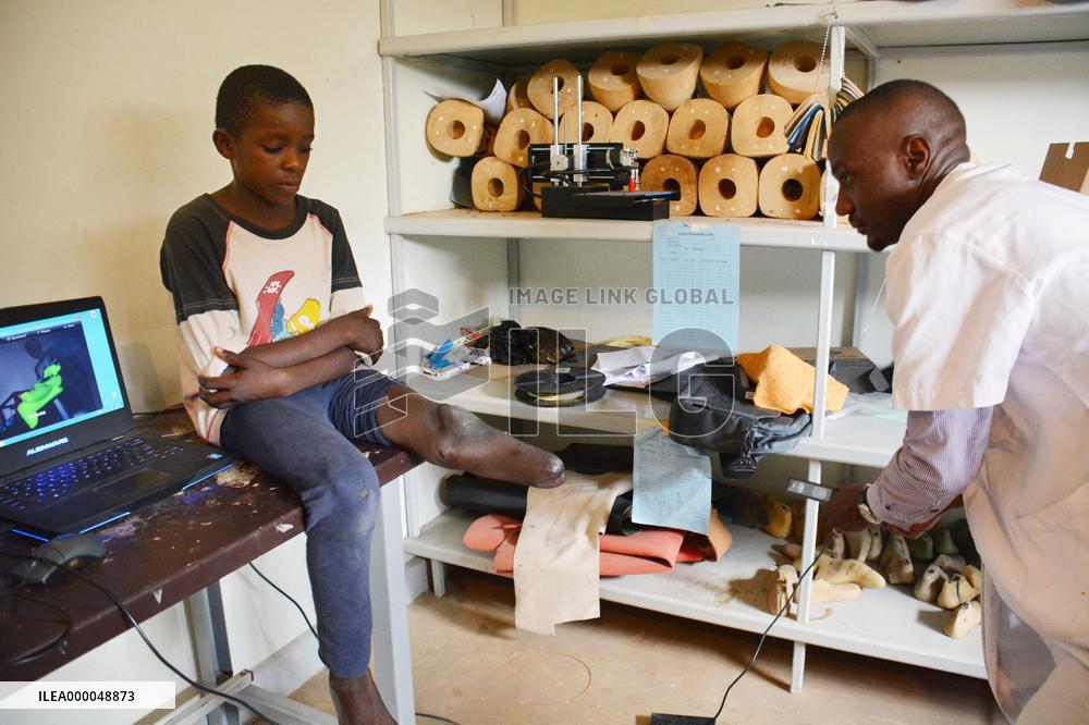 Ugandan hospital scans boy's leg to make prosthesis with 3D printer