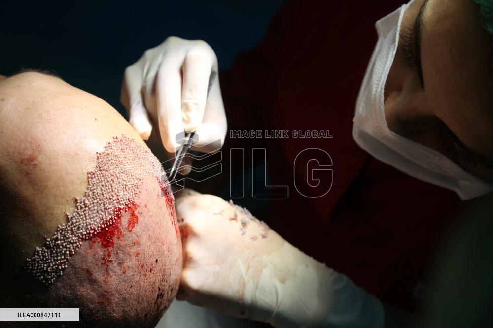 Hair Implants - Turkey