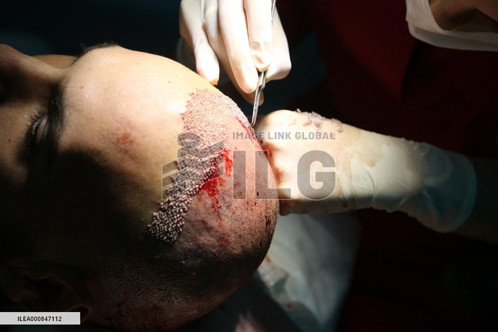 Hair Implants - Turkey