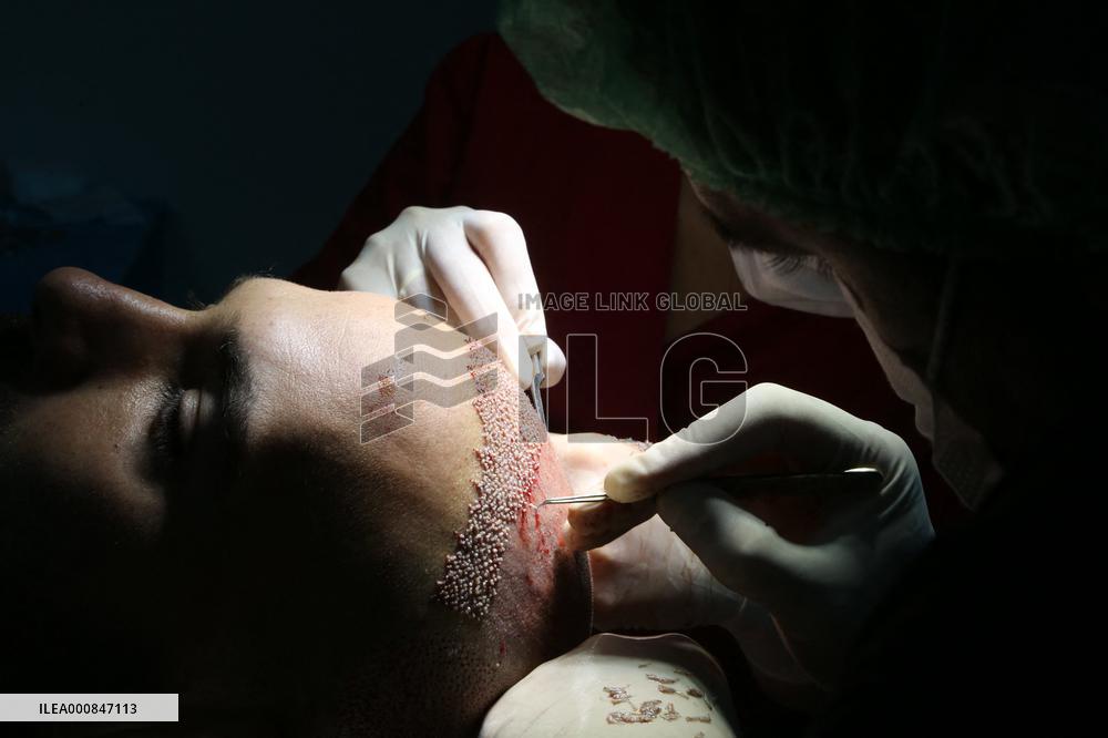 Hair Implants - Turkey