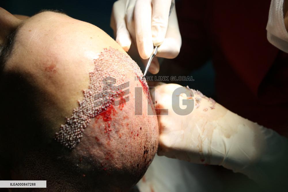 Hair Implants - Turkey