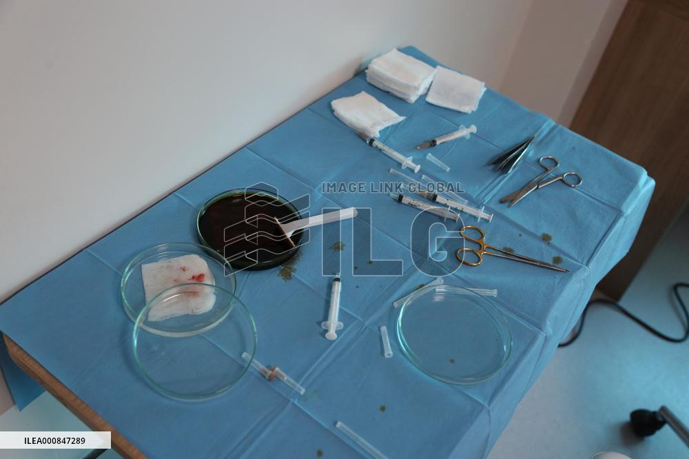 Hair Implants - Turkey