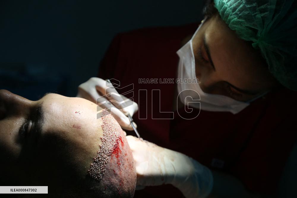 Hair Implants - Turkey