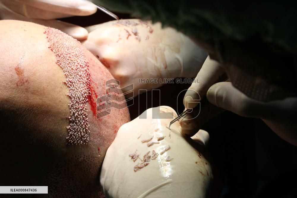 Hair Implants - Turkey