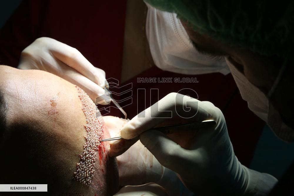 Hair Implants - Turkey