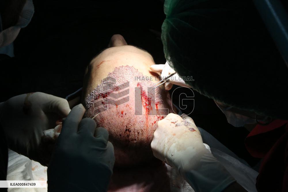 Hair Implants - Turkey