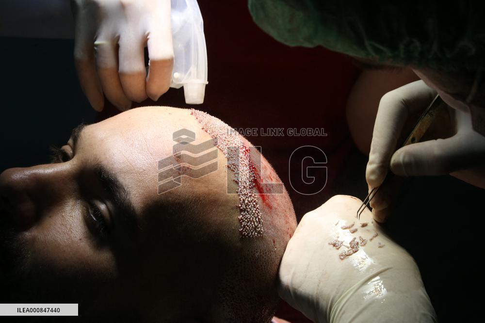 Hair Implants - Turkey