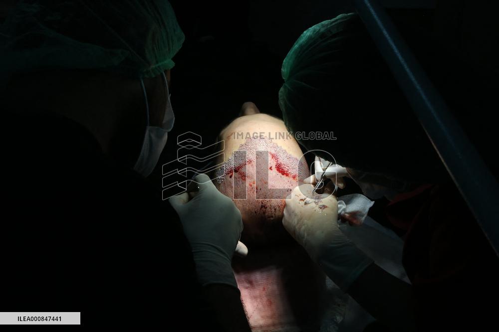 Hair Implants - Turkey