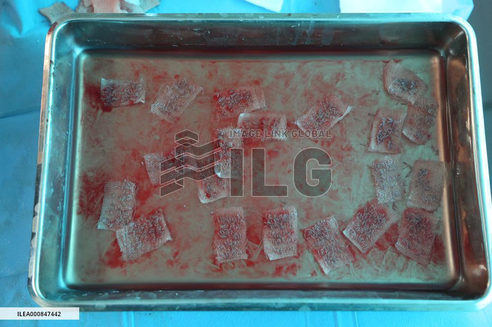 Hair Implants - Turkey