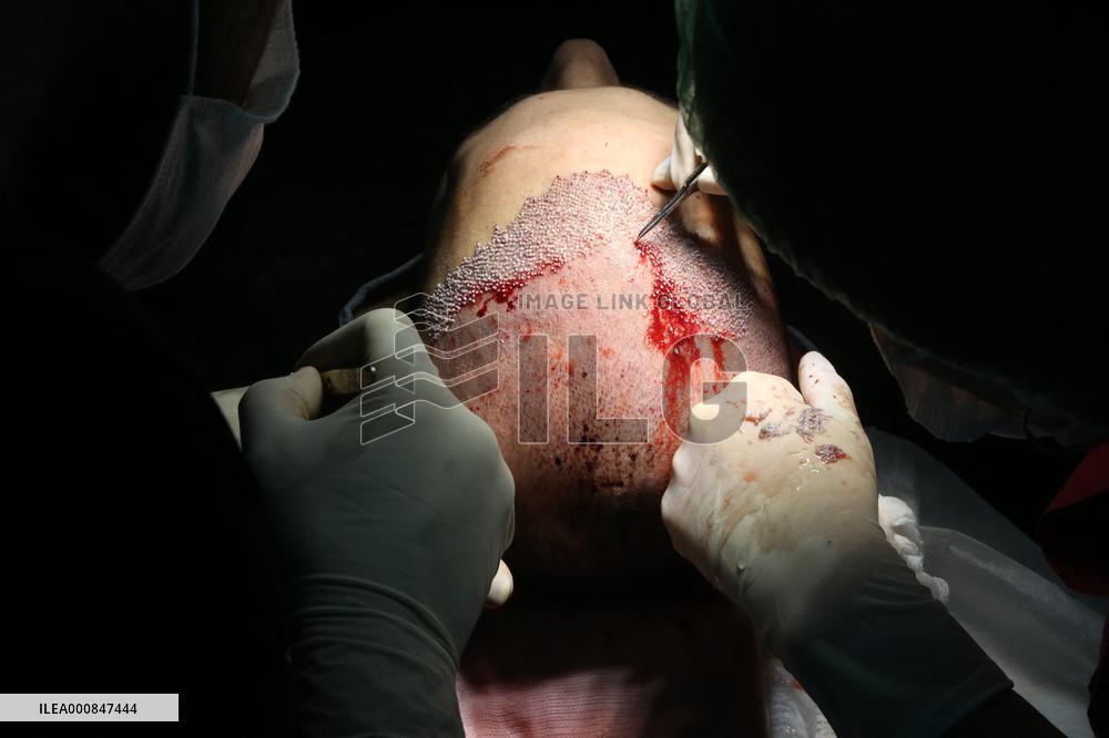 Hair Implants - Turkey