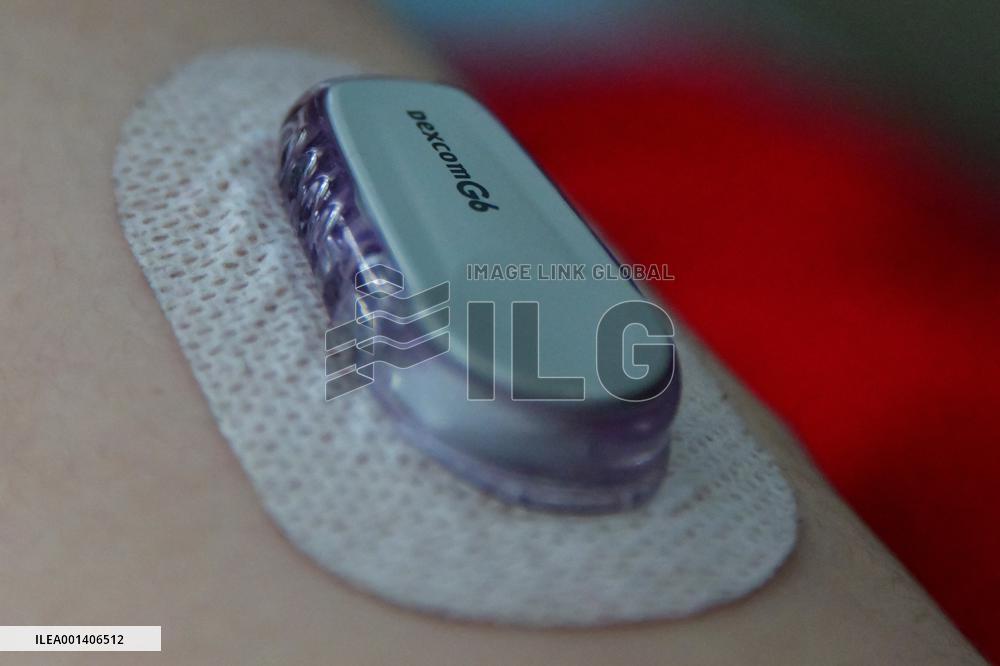 Illustration Monitoring And Treatment Of Type 1 Diabetes