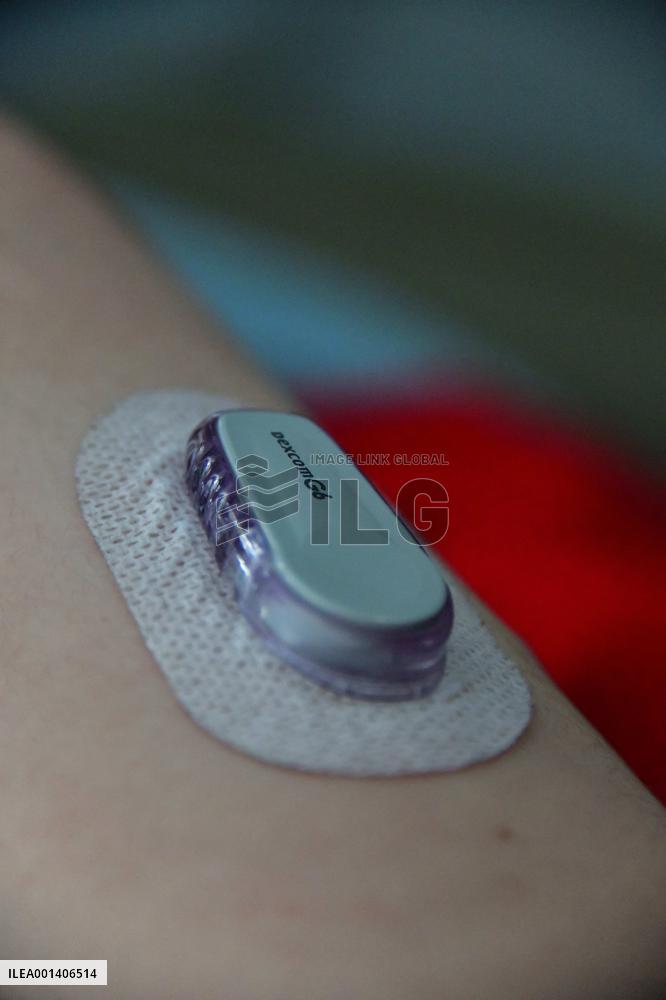 Illustration Monitoring And Treatment Of Type 1 Diabetes