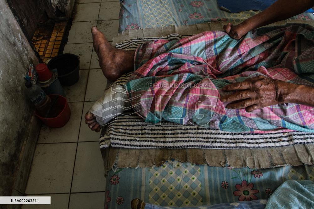 The Burden Of Leprosy In Indonesia