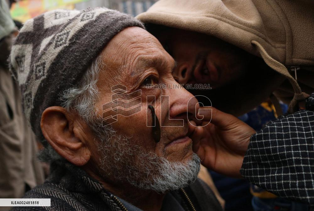 Leech Therapy Treatments - India