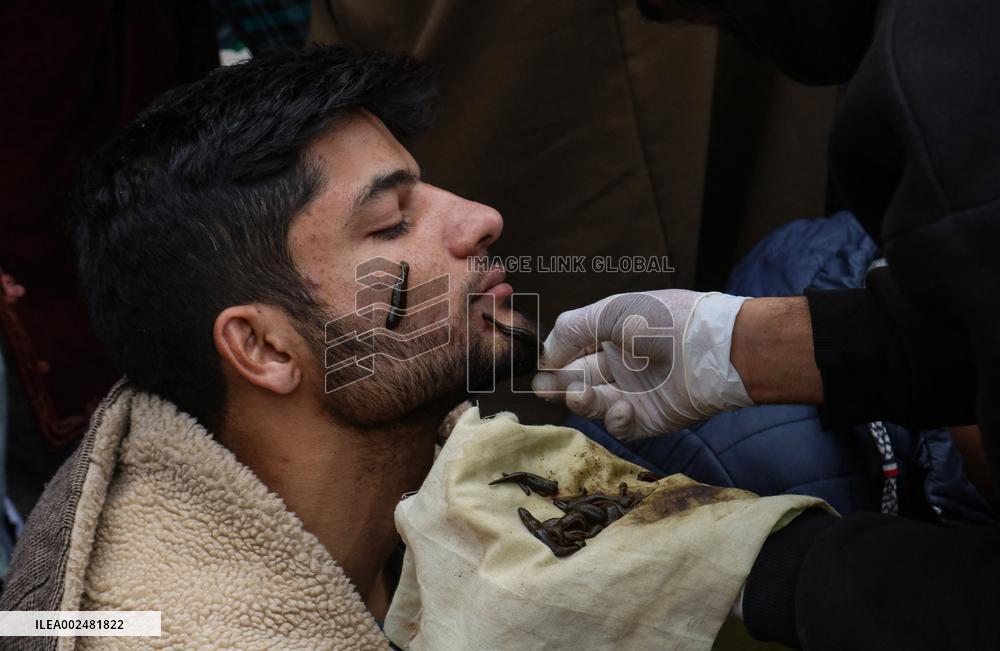 Leech Therapy Treatments - India