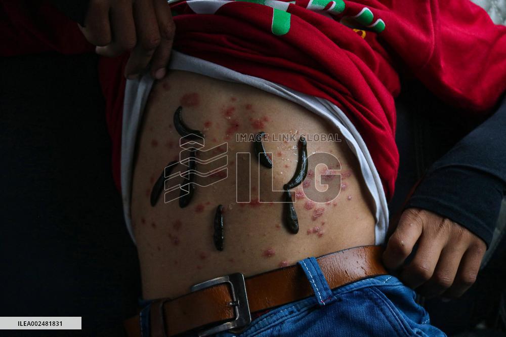 Leech Therapy Treatments - India