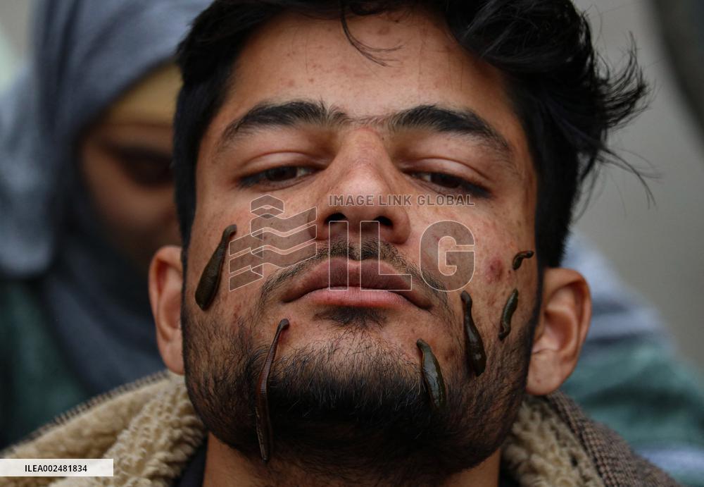 Leech Therapy Treatments - India