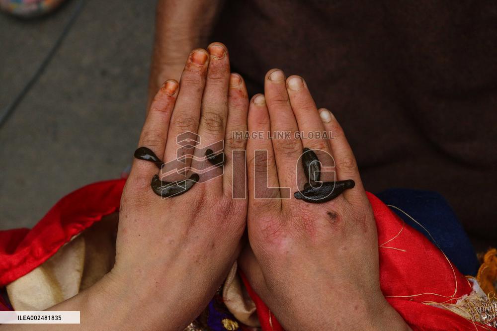 Leech Therapy Treatments - India