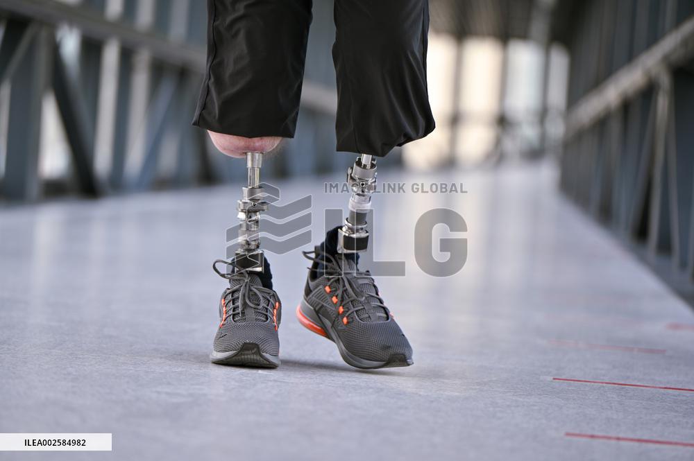 One year after osseointegration treatment of Ukrainian Captain Ihor Krupnov