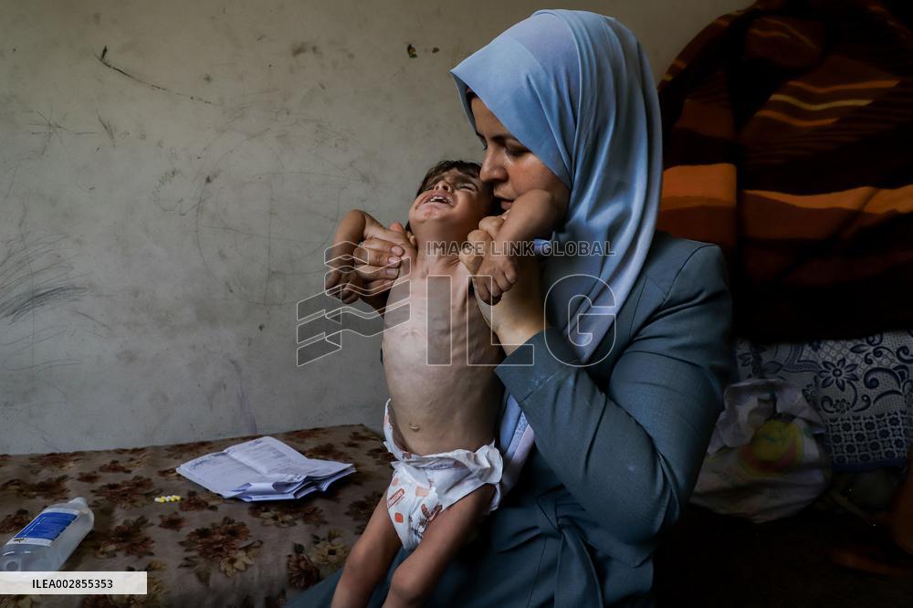 Severe Malnutrition and Dehydration Palestinian Children - Gaza