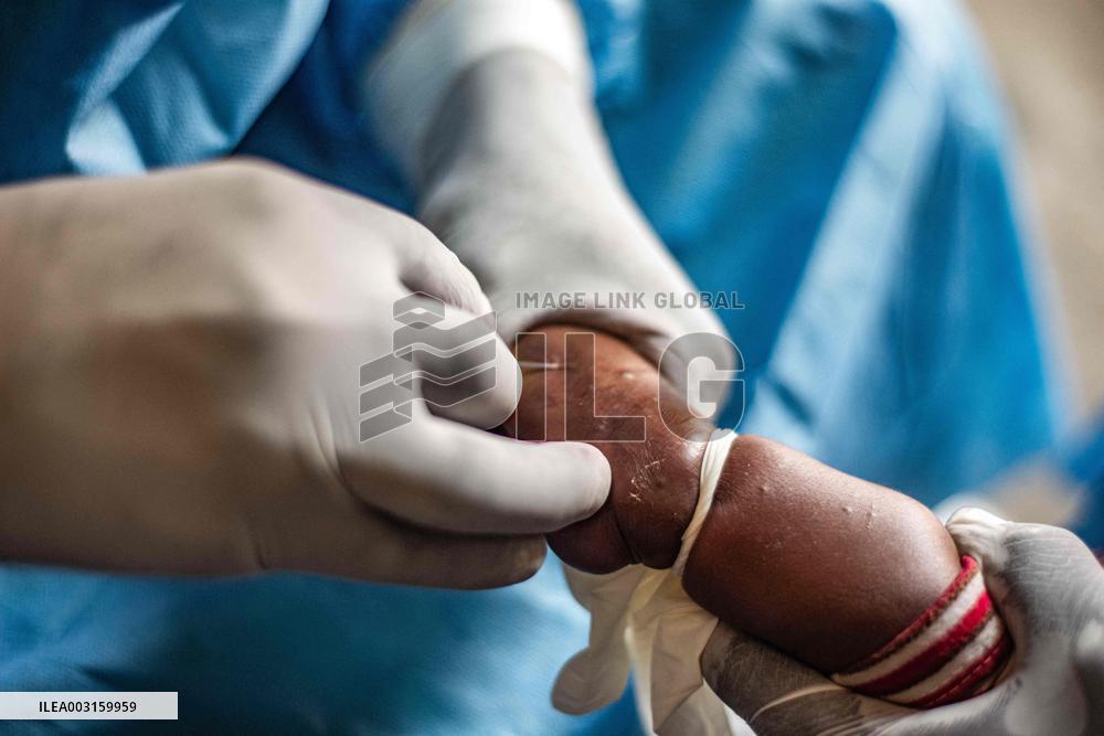 WHO Declares Mpox A Global Public Health Emergency