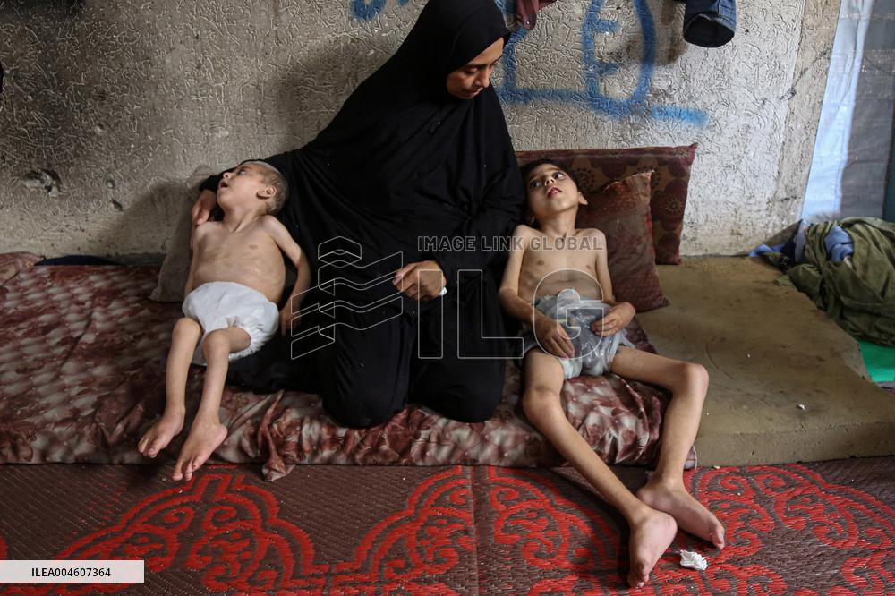 Children malnutrition in Gaza