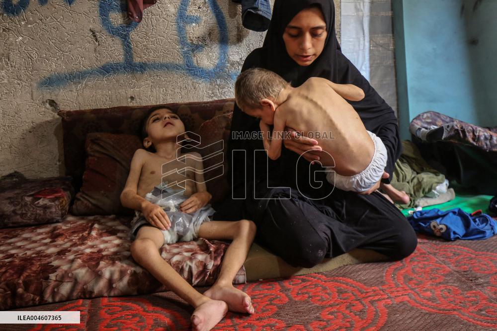 Children malnutrition in Gaza