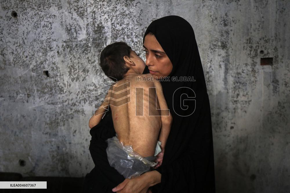 Children malnutrition in Gaza