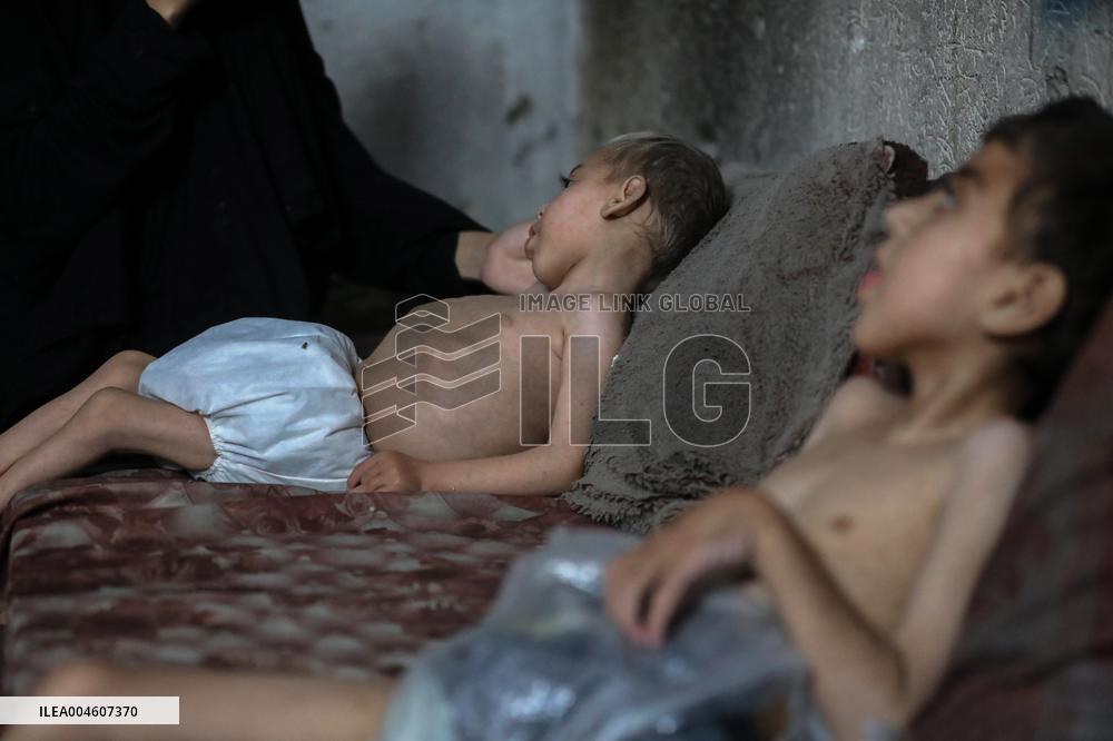 Children malnutrition in Gaza