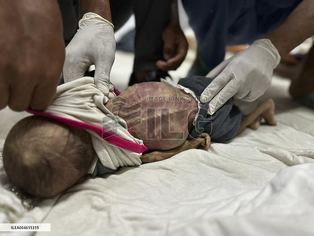 Infant Dies of Malnutrition in Hospital - Khan Yunis