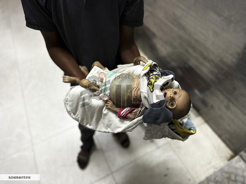 Infant Dies of Malnutrition in Hospital - Khan Yunis