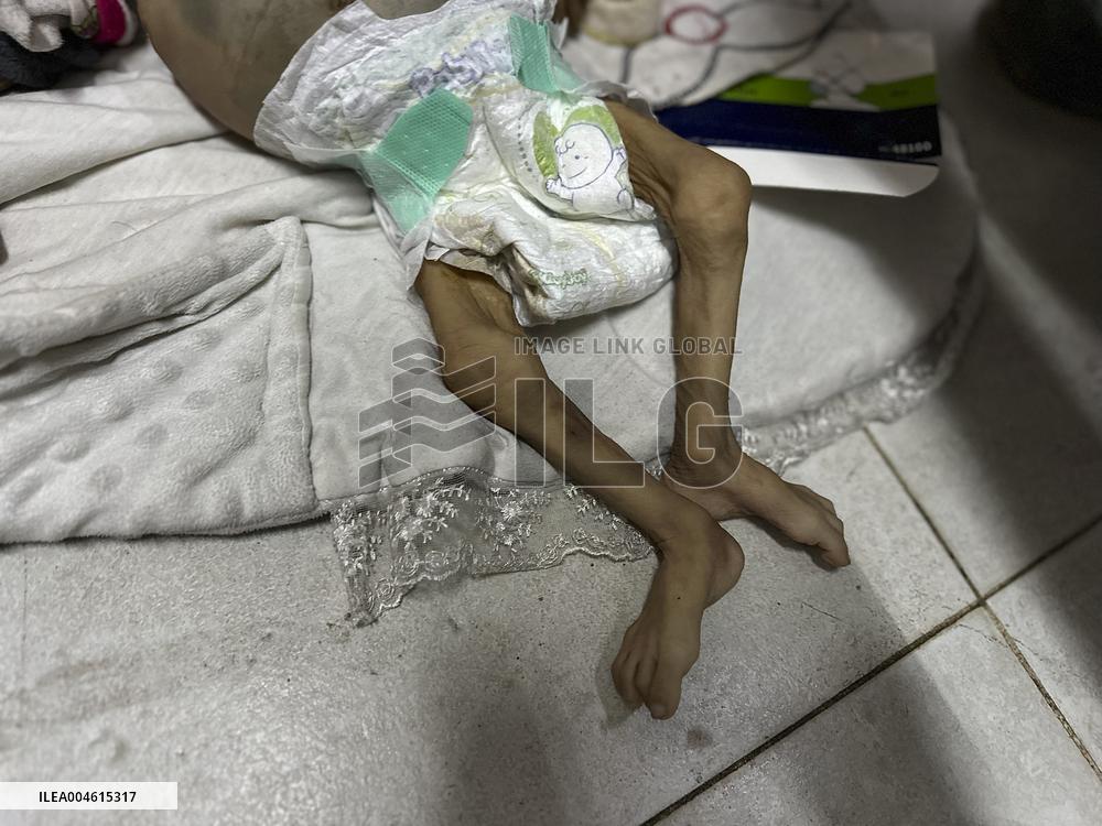 Infant Dies of Malnutrition in Hospital - Khan Yunis
