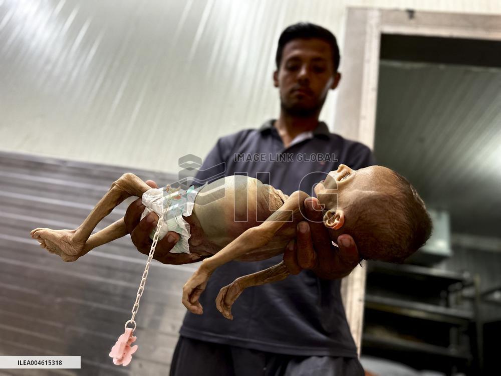 Infant Dies of Malnutrition in Hospital - Khan Yunis