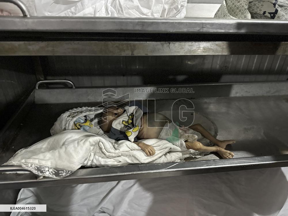 Infant Dies of Malnutrition in Hospital - Khan Yunis