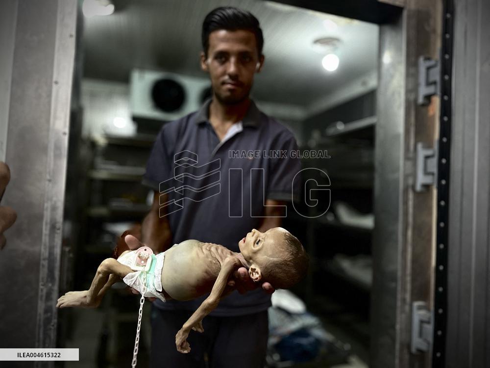 Infant Dies of Malnutrition in Hospital - Khan Yunis