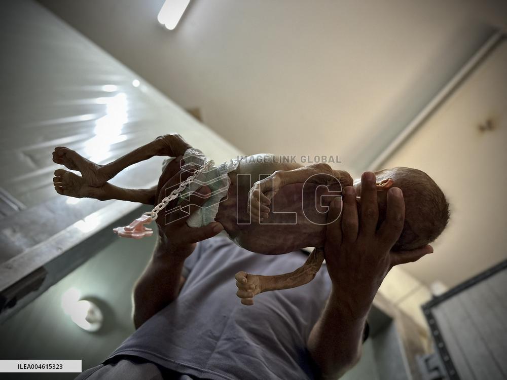 Infant Dies of Malnutrition in Hospital - Khan Yunis