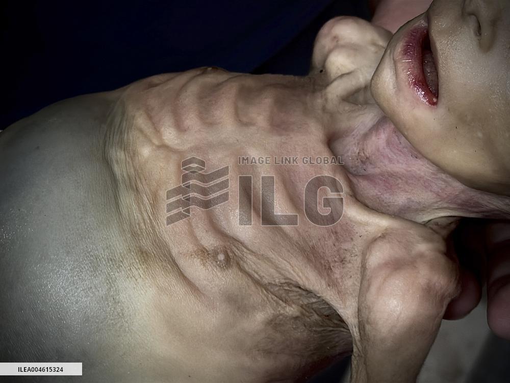 Infant Dies of Malnutrition in Hospital - Khan Yunis