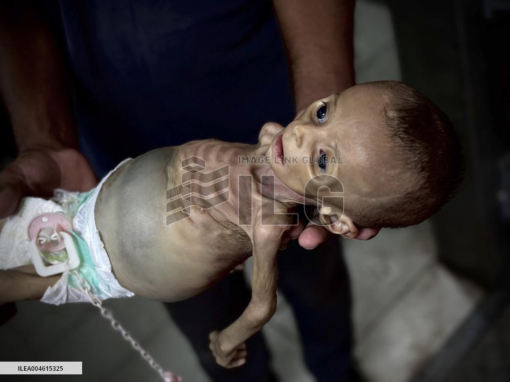 Infant Dies of Malnutrition in Hospital - Khan Yunis