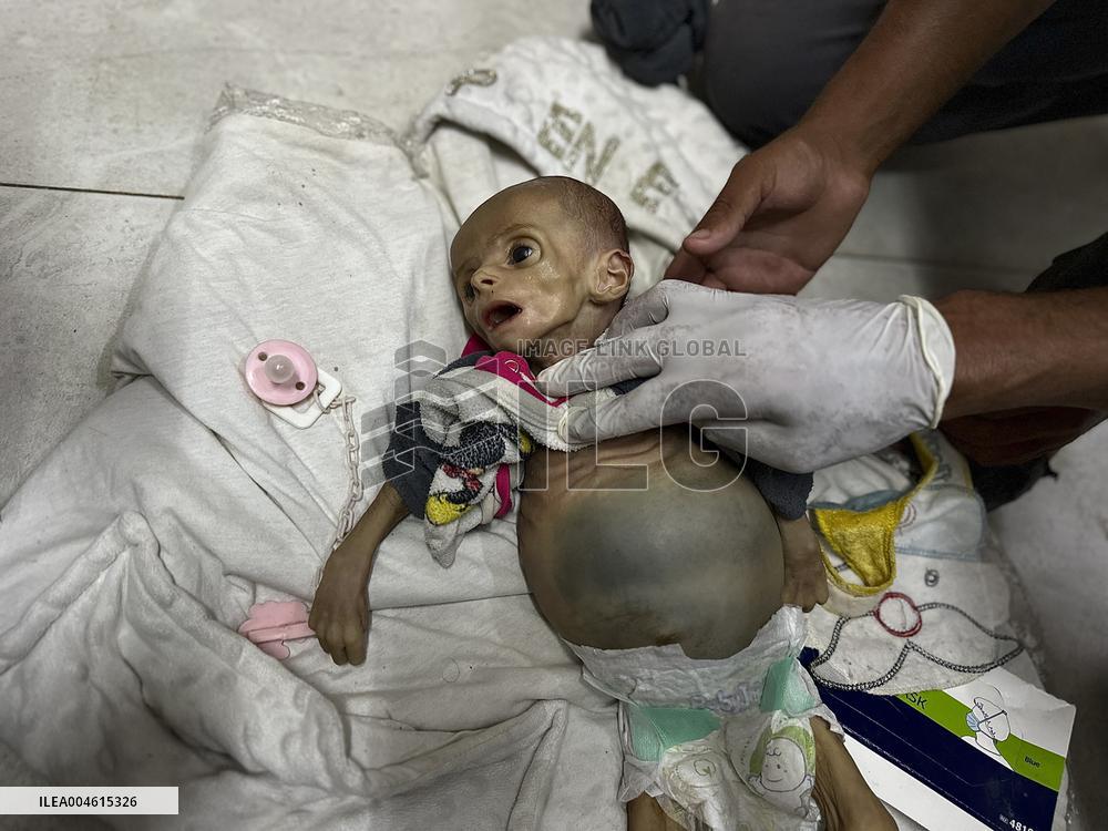 Infant Dies of Malnutrition in Hospital - Khan Yunis