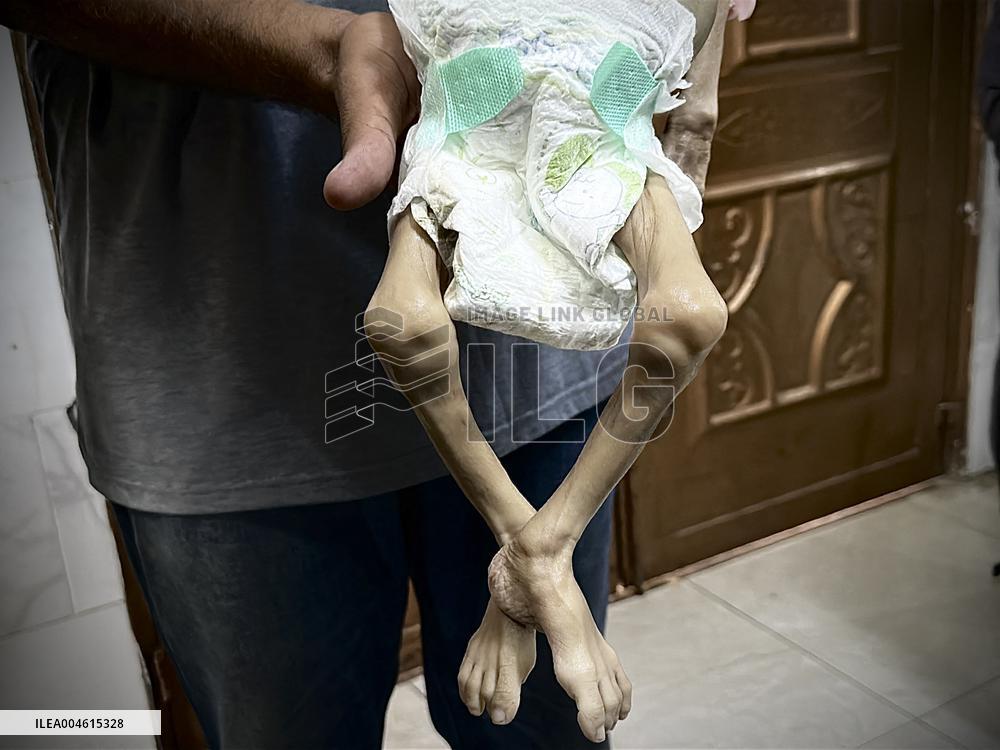 Infant Dies of Malnutrition in Hospital - Khan Yunis