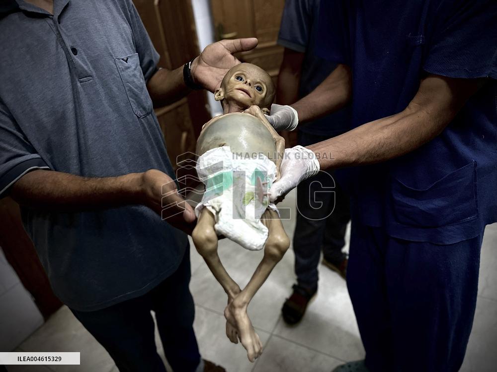 Infant Dies of Malnutrition in Hospital - Khan Yunis