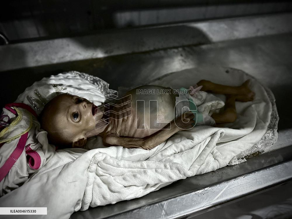 Infant Dies of Malnutrition in Hospital - Khan Yunis