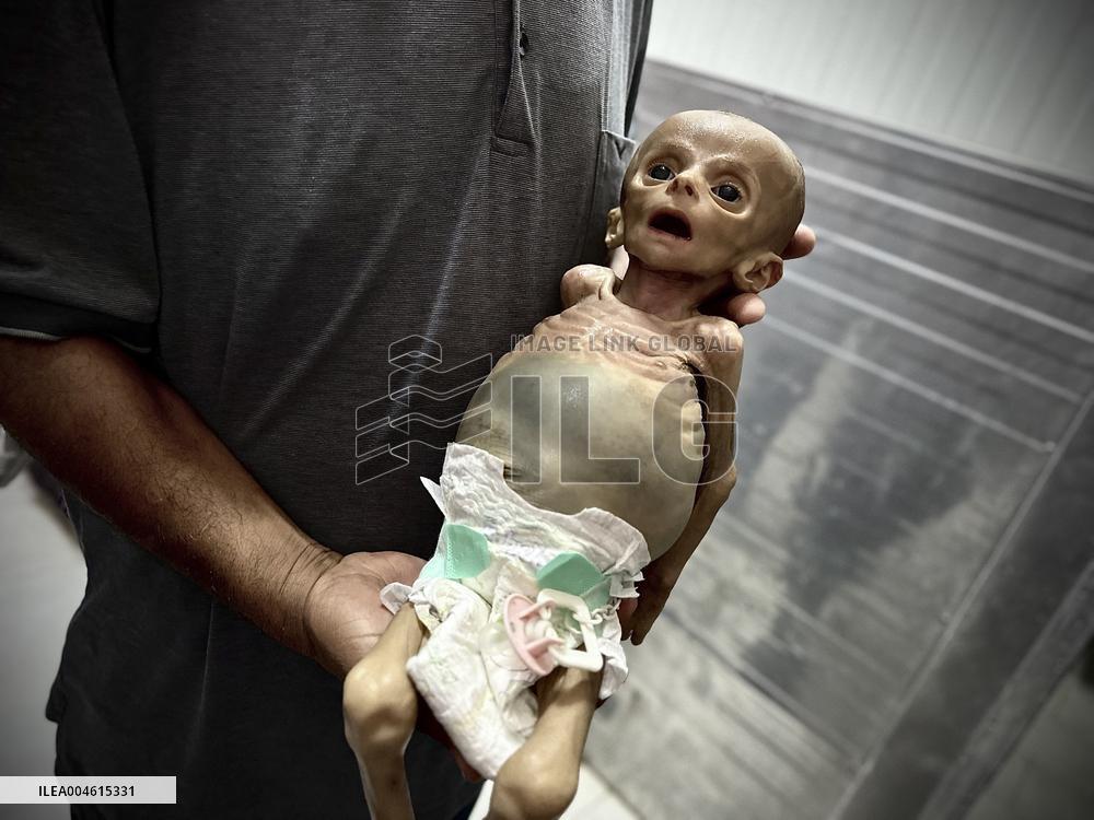 Infant Dies of Malnutrition in Hospital - Khan Yunis