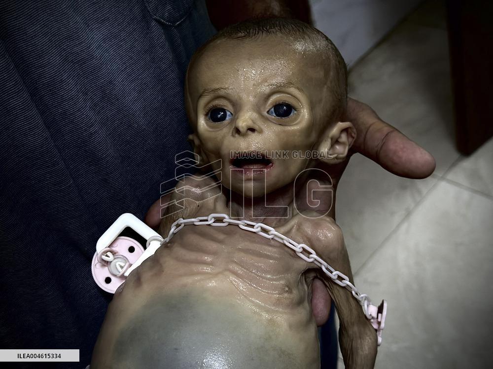 Infant Dies of Malnutrition in Hospital - Khan Yunis