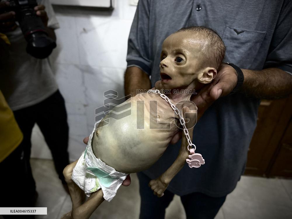 Infant Dies of Malnutrition in Hospital - Khan Yunis