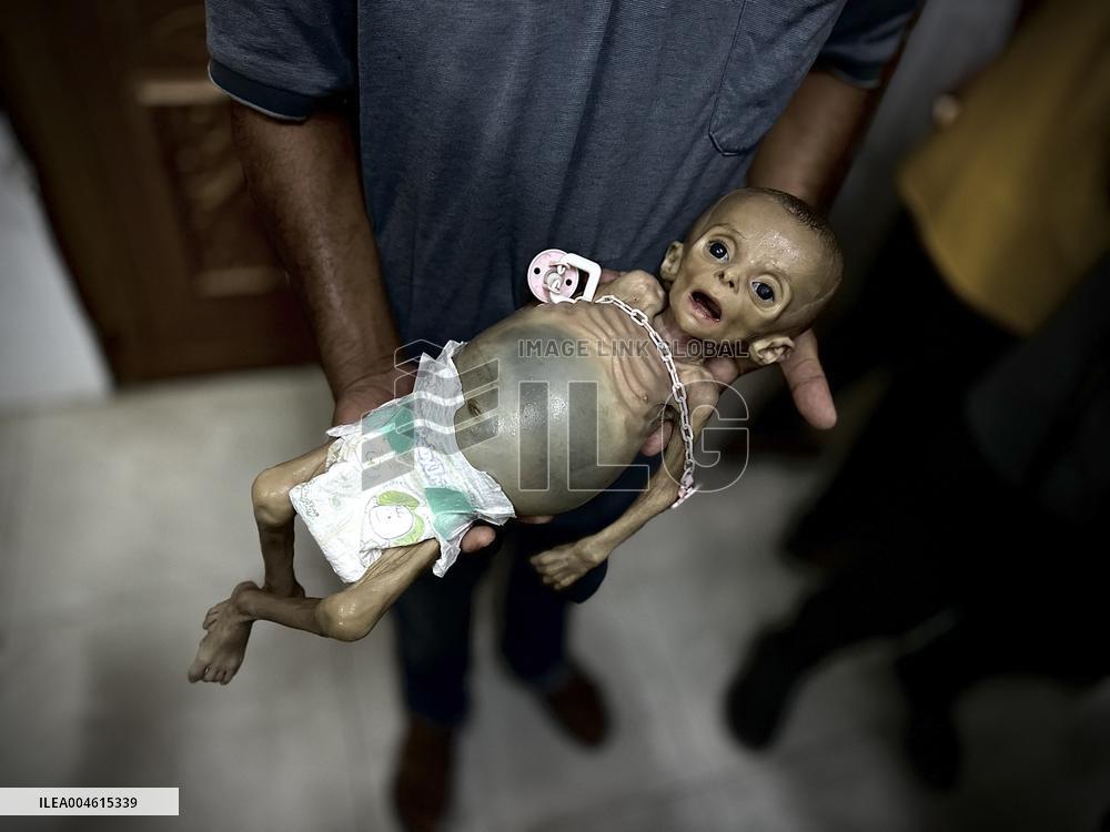 Infant Dies of Malnutrition in Hospital - Khan Yunis