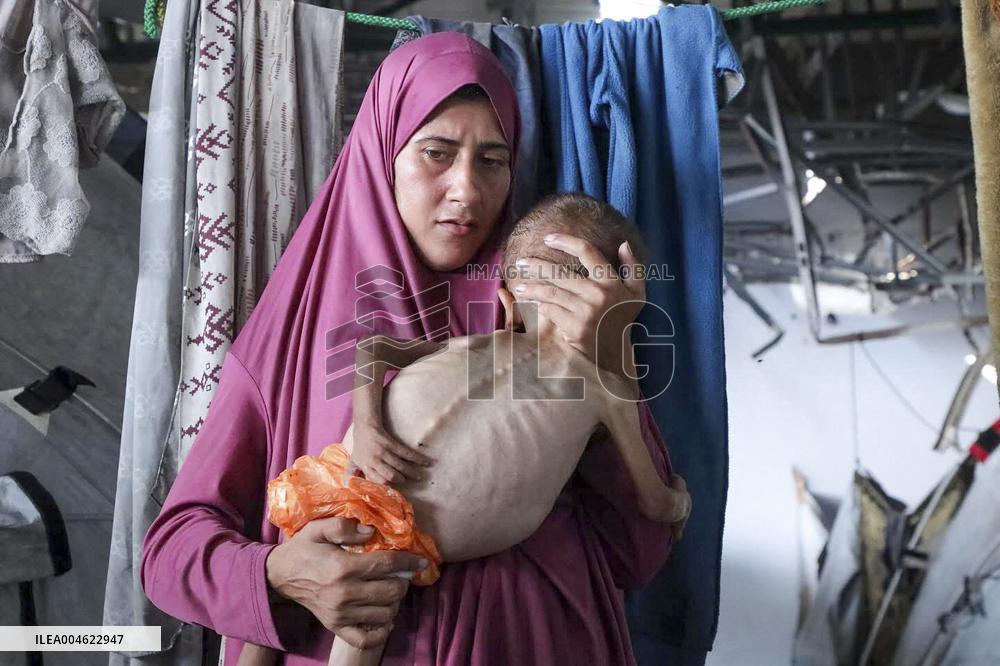 Malnourished Baby Highlights Gaza Crisis