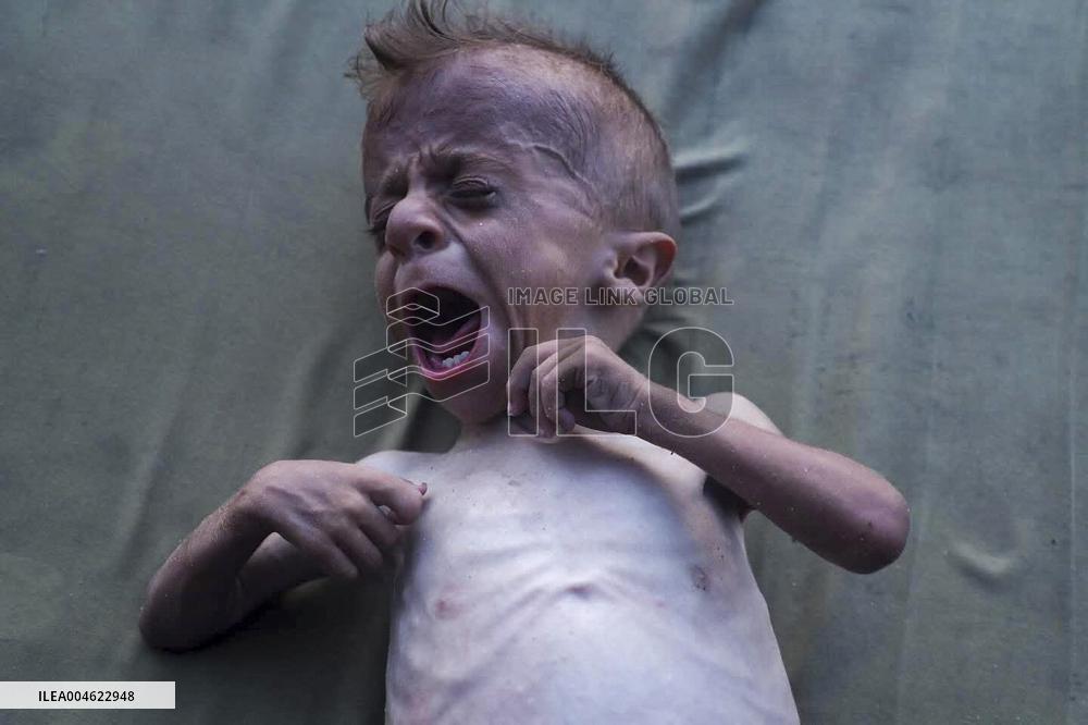Malnourished Baby Highlights Gaza Crisis