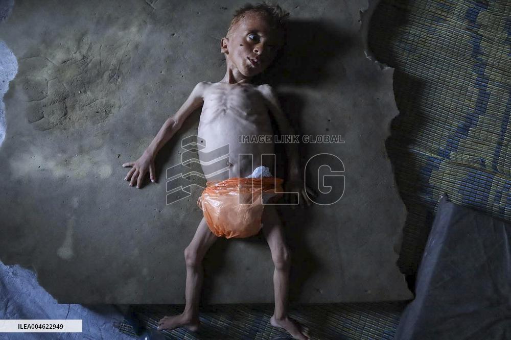 Malnourished Baby Highlights Gaza Crisis