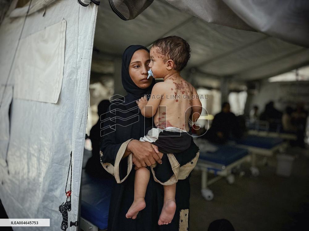 Gaza Children Skin Diseases - Khan Yunis